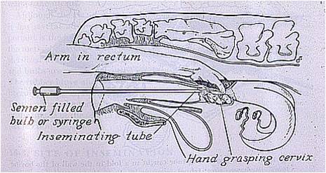 Cathétérisme cervical voie recto-vaginale